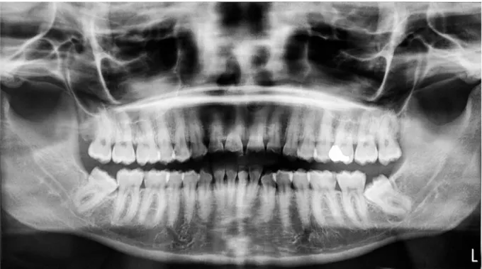 Figure 13 : Radiographie panoramique de Mme. L 