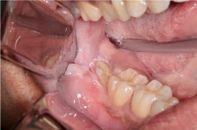 Figure 18 : Anesthésie puis incision en épaisseur totale 