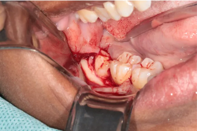 Figure 20 : Ostéoectomie vestibulaire avec fraise boule carbure de tungstène sous irrigation 