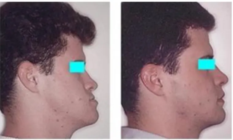 Figure n° 13: individu avant et après chirurgie orthognathique. [11]