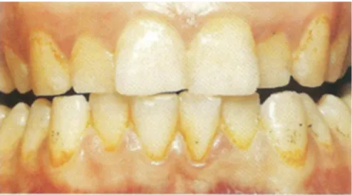 Figure 2 : Coloration orange associée à une accumulation de plaque   (7) 
