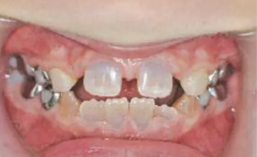 Figure 7 : Dentinogenèse imparfaite avec coloration gris bleuté   (63) 