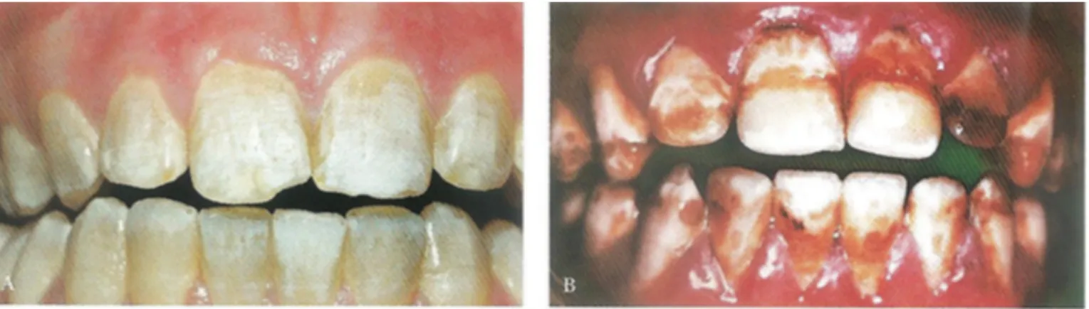 Figure 9 : Fluorose légère de score 3 (A) et fluorose sévère de score 5 (B)  (7) 