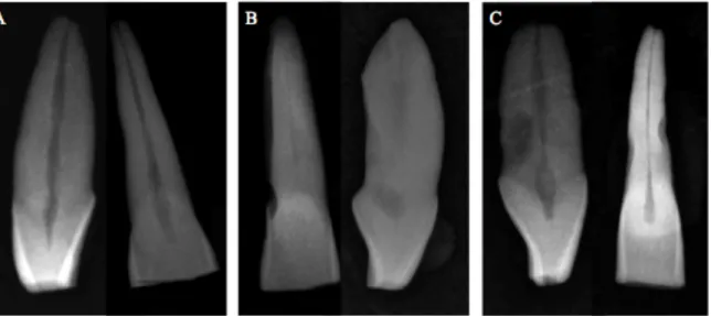 Figure 5 : Exemples de dents exclues de l’étude après radiographie préopératoire de face  et de profil : 