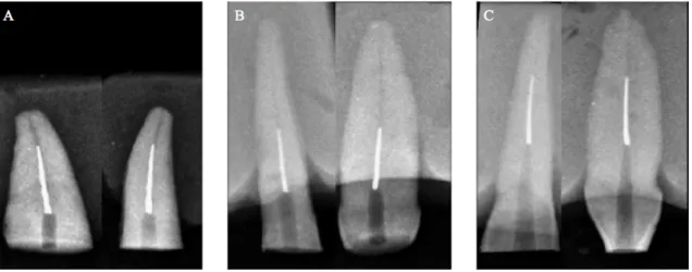 Figure  11 :  Radiographie  retro  alvéolaire  de  face  et  de  profil  après  avoir  ajusté  la  longueur  de  travail  de  chaque  dent  pour  qu’elle  corresponde  à  celle  de  leur  groupe  d’assignation