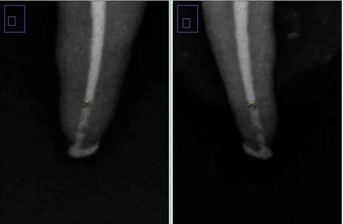 Figure 4 Calcul des manques avec ImageJ® 