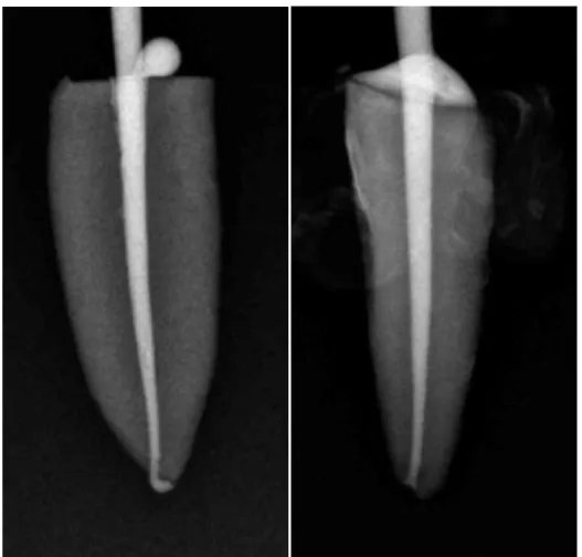 Figure 10 Dépassement MC LT Total Fill BC Sealer® vs Bioroot RCS® 