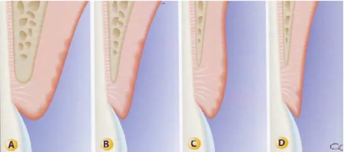 Figure 7 : Les types de parodonte selon Korbendau et Guyomard : A. Type I, B. Type II, C
