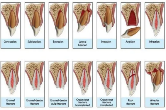 Figure 7 : Classification des différents traumatismes dentaires  (20)   