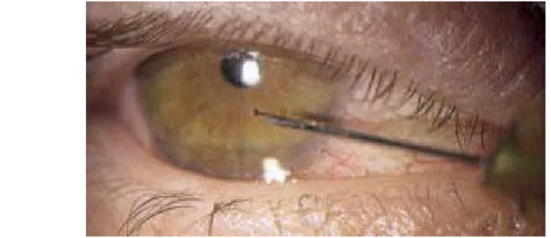 Figure 3 : Ablation d'un corps étranger cornéen à l'aiguille E.TUIL