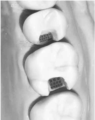 Figure 5 : E-optotypes miniaturisés placés dans des cavités distales de molaires et prémolaires