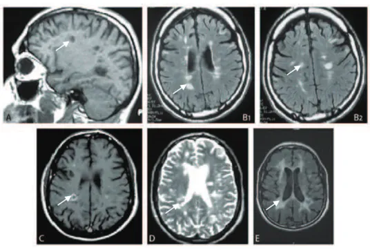 Figure 3 : Imagerie cérébrale dans la SEP   