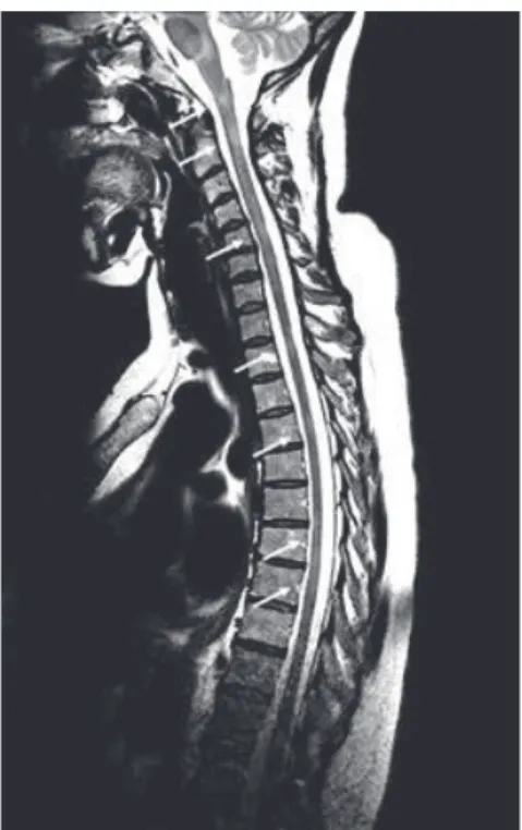 Figure 4 : Imagerie médullaire dans la SEP 