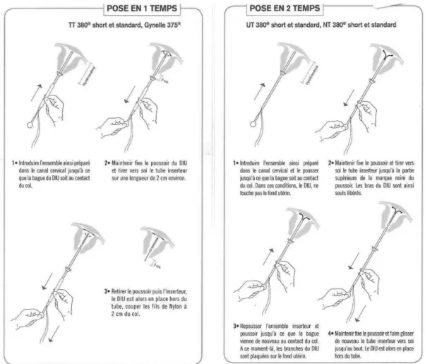 Figure 4. Mécanismes de pose d'un DIU au cuivre  Source : Brochure « DIU au cuivre – A chacune son modèle »,  