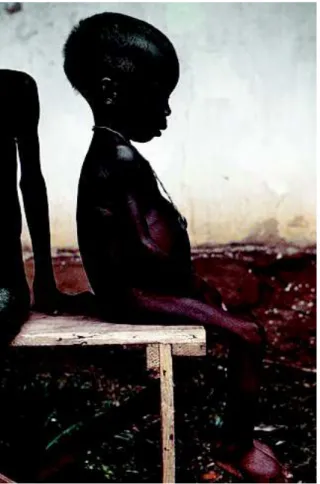 Figure  n°4 :  fin  des  années  1960  d’une  fillette atteinte de kwashiorkor au cours de la  guerre du Biafra