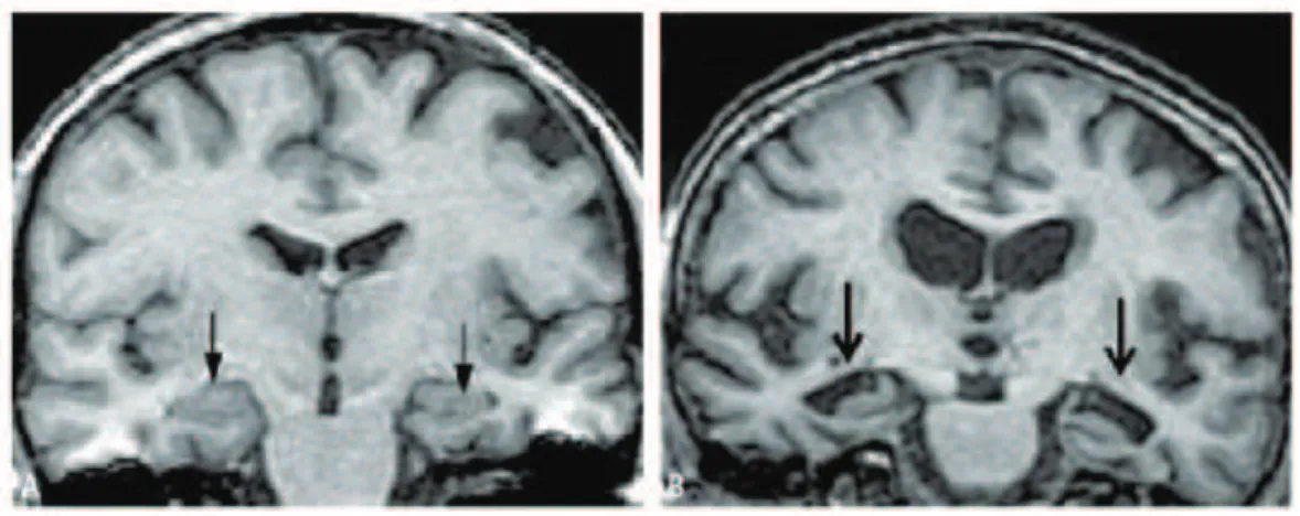 Figure 4 : IRM cérébral  Les flèches localisent les hippocampes 