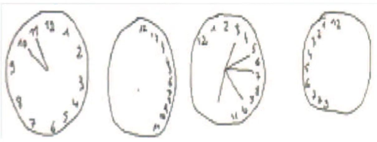 Figure 6 : test de l'horloge réalisé par des patients atteints de la maladie d’Alzheimer souffrant de troubles spatiaux  (site n°26) 