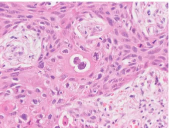 Fig. 4 : Absence d’immunoréactivité pour le collagène IV des mem- mem-branes basales péri-tumorales