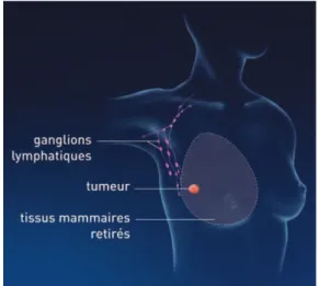 Figure 5 : La mastectomie totale  (d'après INCa, 2013) 