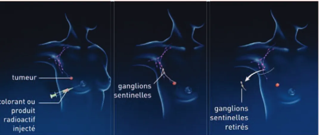 Figure 7 : L’exérèse des ganglions sentinelles  (d'après INCa, 2013) 