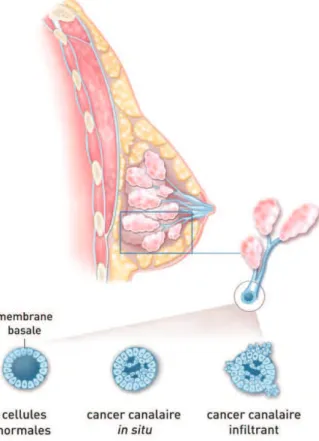 Figure 8 : Cancer canalaire in situ et infiltrant  (d'après INCa, 2013) 