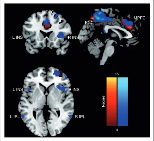 Figure 1. Spatial characteristics of the areas of the Default Mode Network included in the seed-based resting state analysis for MI patients (in blue) and HV (in yellow/red): Posterior cingulate cortex (PCC), inferior parietal lobule (IPL), medial prefront