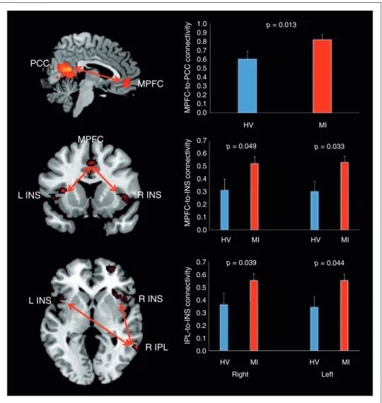 Figure 2. Default Mode Network (DMN) inter-regional resting state-functional connectivity in migraine patients during an attack (MI) and healthy volunteers (HV)