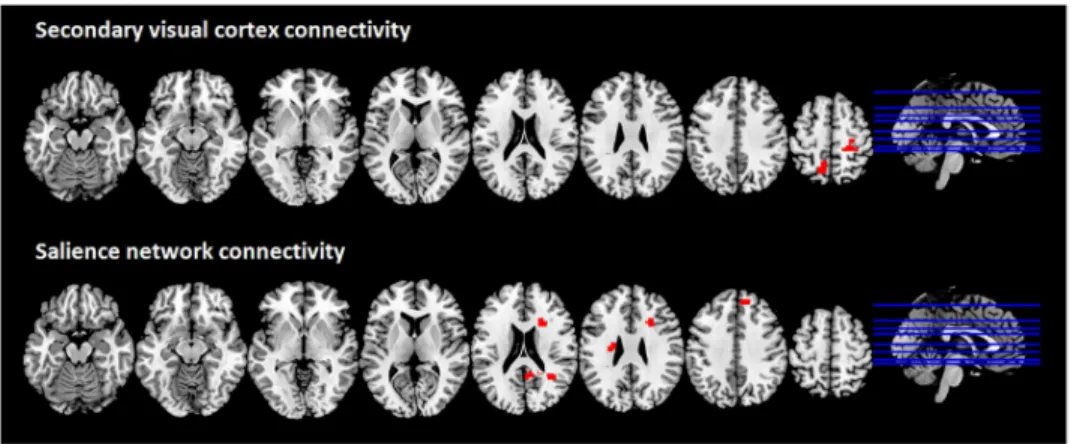 Fig 2. Brain regions showing increased functional connectivity with the secondary visual cortex and the salience network in the CBS patient compared to C-CBS group; multislice view of the regions overlaid on the MNI template; topological non-parametric cor
