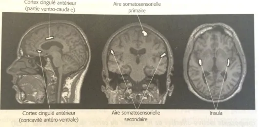 Figure 18 : Les régions corticales de la douleur - coupes cérébrales d'imagerie par  résonance magnétique (IRM) (Marchand, 2009)