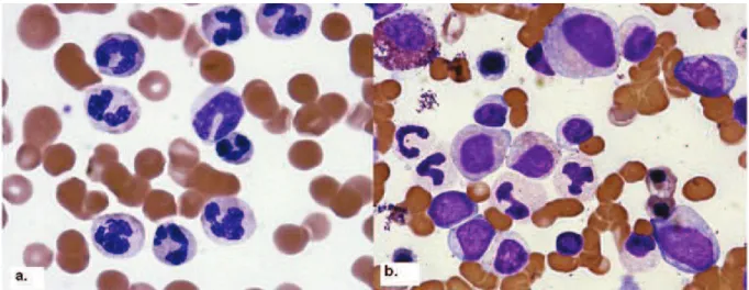 Figure 1. Frottis sanguin et médullaire de la LMC-a. Image de Fend F. et al (Leuk. Res