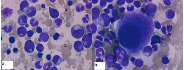 Figure  11.  Aspect  de  la  LMMC  dans  une  moelle,  coloration  MGG  (images  issues  du  laboratoire  d’hématologie  du  CHU  de  Rouen)