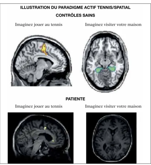 Fig. 5 : En haut : Région cérébrale activée (i.e., aire motrice supplémentaire) – en jaune – au  cours de la tâche “Imaginez jouer au tennis” et – en vert – au cours de la tâche “Imaginez   visiter votre maison” (i.e., gyrus parahippocampique) chez un suje