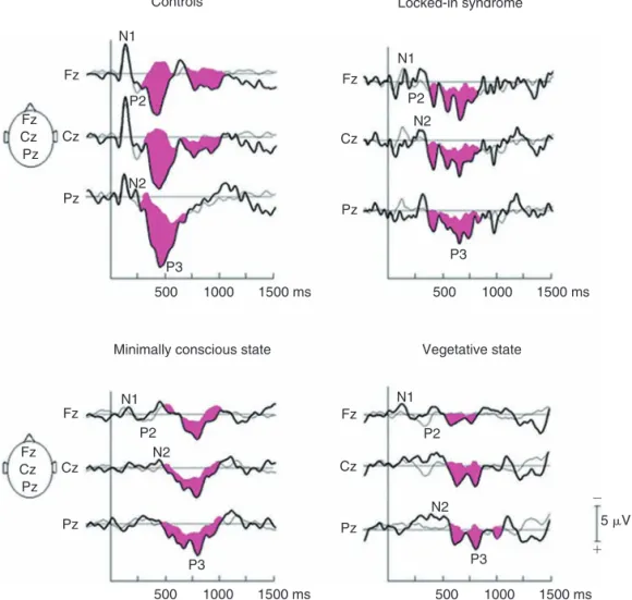 FIGURE 15.6          ERPs to the subject’s own name (thick traces) and to other first names (thin traces) in controls (  n        ⫽       5),  LIS  ( n        ⫽       4),  minimally  conscious state (  n        ⫽       6)  and  vegetative  state  ( n      
