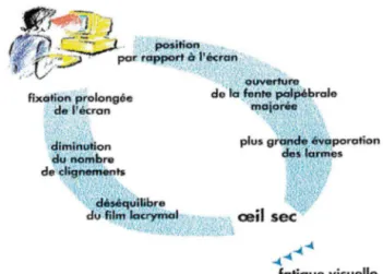 Figure  5:  le  syndrome  de  l'écran  de  visualisation 