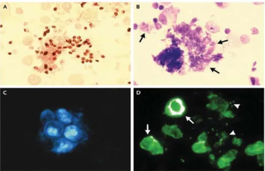 Figure 8: Colorations permettant la mise en évidence de Pneumocystis à l'examen  direct (d'après Thomas et Limper, N Eng J Med, 2004).