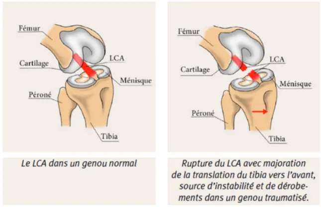 Figure 10 - Illustration d'une rupture du ligament croisé antérieur (47) 