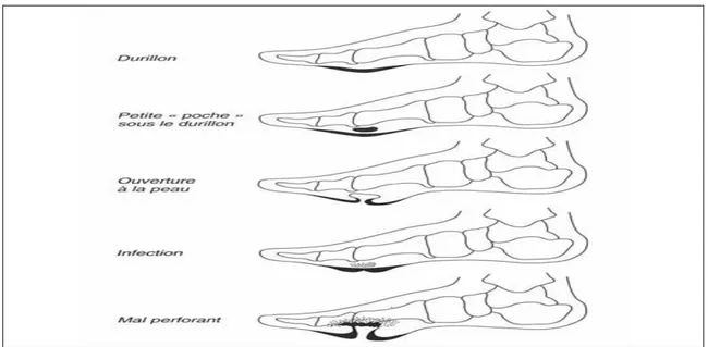 Figure 6: Evolution vers un mal perforant plantaire 