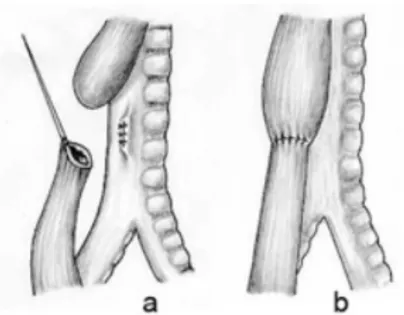 Figure 7: Mode opératoire d'une AO de type III a) Repérage de la FTO, elle est ensuite  sectionnée, puis réparation de la paroi trachéale b) Réalisation de l’anastomose 