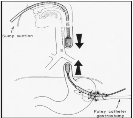 Figure 9: Méthode du bouginage (35) 