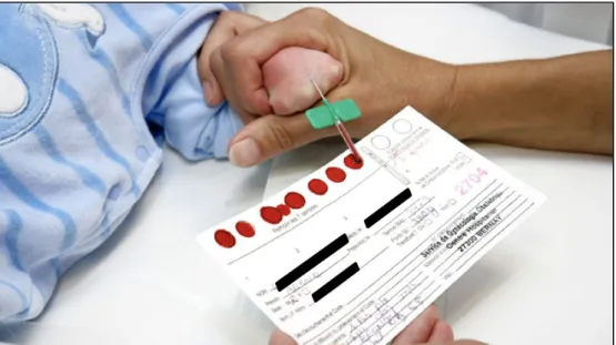 Figure 3 - Prélèvement sanguin sur carton Guthrie du dépistage néonatal  par veinoponction au dos de la main