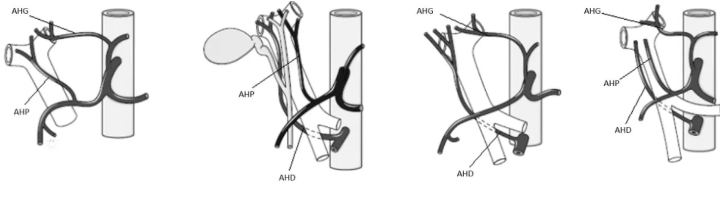 Figure 6 : Variantes anatomiques de la vascularisation hépatique (12). 