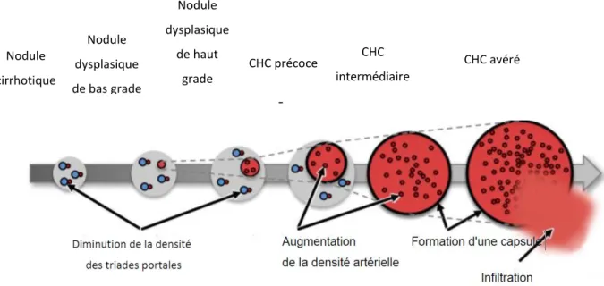 Figure 1 Hépatocarcinogénèse multi-étapes 