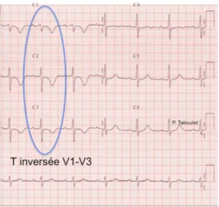 Figure 6. Electrocardiogramme d'un patient présentant une HTAP sévère 