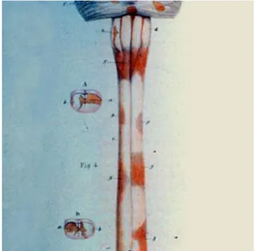 Figure  1.  Image  des  lésions  médullaires,  tirée  de  l’ouvrage  de  Robert  Carswell  (  D’après  Papeix 2011)