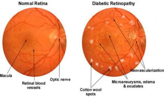 Figure 6 : Rétinopathie diabétique : Comparaison d’une rétine normale avec une rétine de patient diabétique   souffrant d’une rétinopathie (85)
