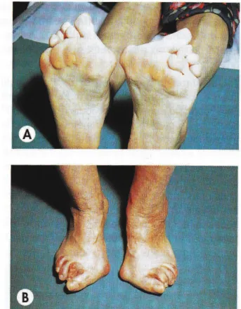Figure 17 : Atteintes des pieds chez les patients atteints de PR (4) :  A : Avant-pieds plats triangulaires avec durillons d’appui ; B : Griffe des orteils