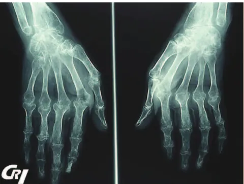 Figure 23 : Aspect radiographique typique d’une PR évoluée ; importantes lésions bilatérales  de carpite à tendances fusionnantes, multiples arthropathies globalement bilatérales et 