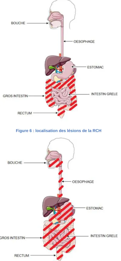 Figure 6 : localisation des lésions de la RCH