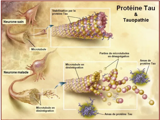Figure 12 : Protéine Tau dans un neurone sain et dans un neurone malade  35 