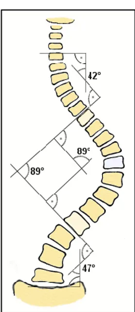 Tableau 3 : Classification de la gravité des scolioses et de leur prise en charge en fonction de  leur degré de courbure (30) 